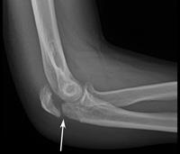 An olecranon fracture usually causes sudden, intense pain and can prevent you from moving your elbow.