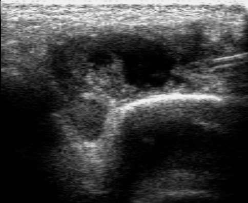 Ultrasound guided Joint injections
