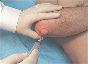 Olecranon bursa Extend the elbow Use 20 gauge needle Aspirate/inject from