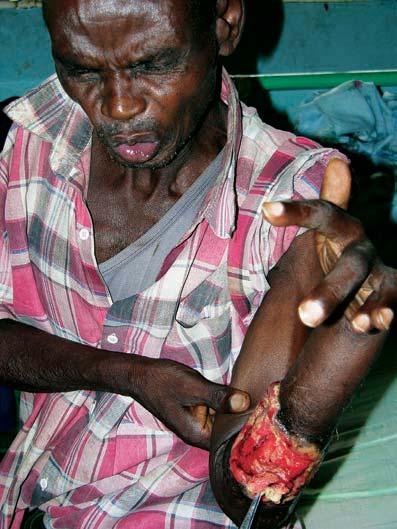 Contact a doctor or health worker when necessary Figure 5.1.7 This affected person has a painful, excessively bleeding ulcer. He had previous BU lesions 40 years ago.