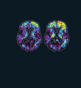 Baseline 24 months Scientific American (June 2010) Alzheimer s: Forestalling the Darkness PET scans show increasing retention in the brain s frontal lobes of