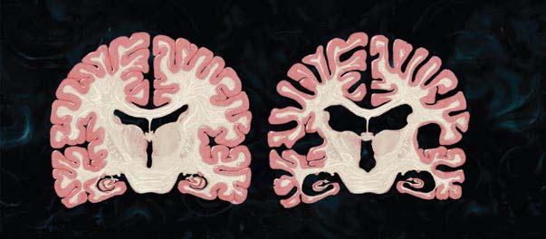 Healthy brain Alzheimer s brain Hippocampus Scientific American (June