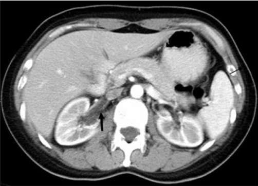 Sequential enhanced axial CT scan of R t kidney on 2002/02/07 reveals the fatty