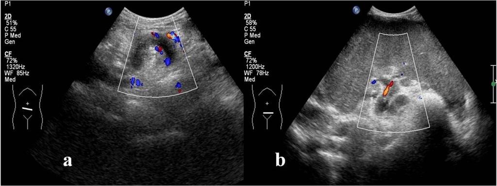 Fig. 1: Ultrasound with colour Doppler shows twisting of the splenic vascular pedicle and a dilated splenic vein with no colour flow within (a).