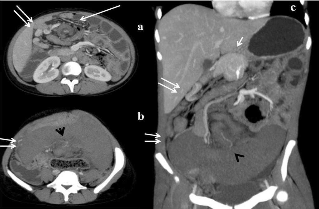The twisted pedicle shows no enhancement of the dilated splenic vein. Spleen shows minimal peripheral enhancement (b, c) with opacification of splenic artery at its hilum (black arrowheads).