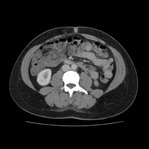 Figure 2. CT showing thickened and irregular small loop with relative enhancement suggestive of intussusception. Case 2.
