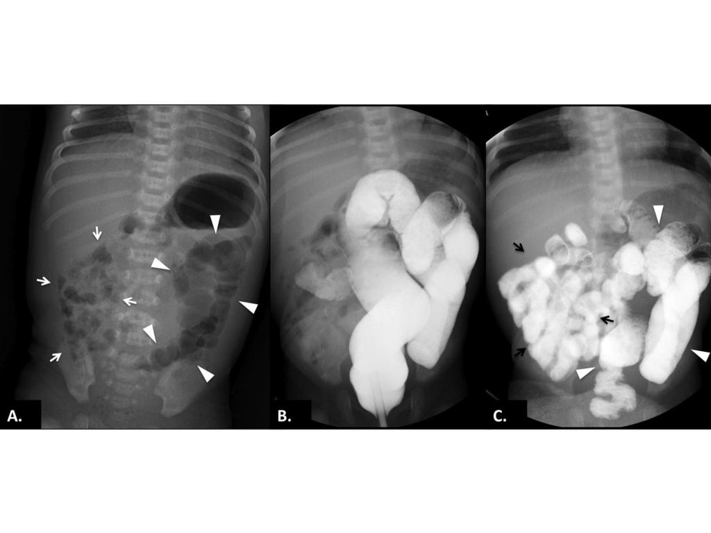 Fig. 7: Conventional radiography and contrast enema in a newborn girl with bilious vomiting.