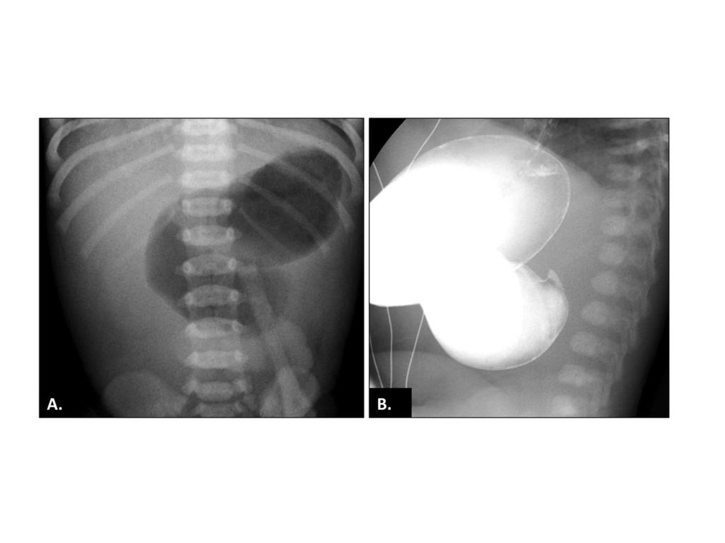 Fig. 8: Conventional radiography and upper GI study in a newborn boy with bilious vomiting and a history of gestational polyhydramnios.