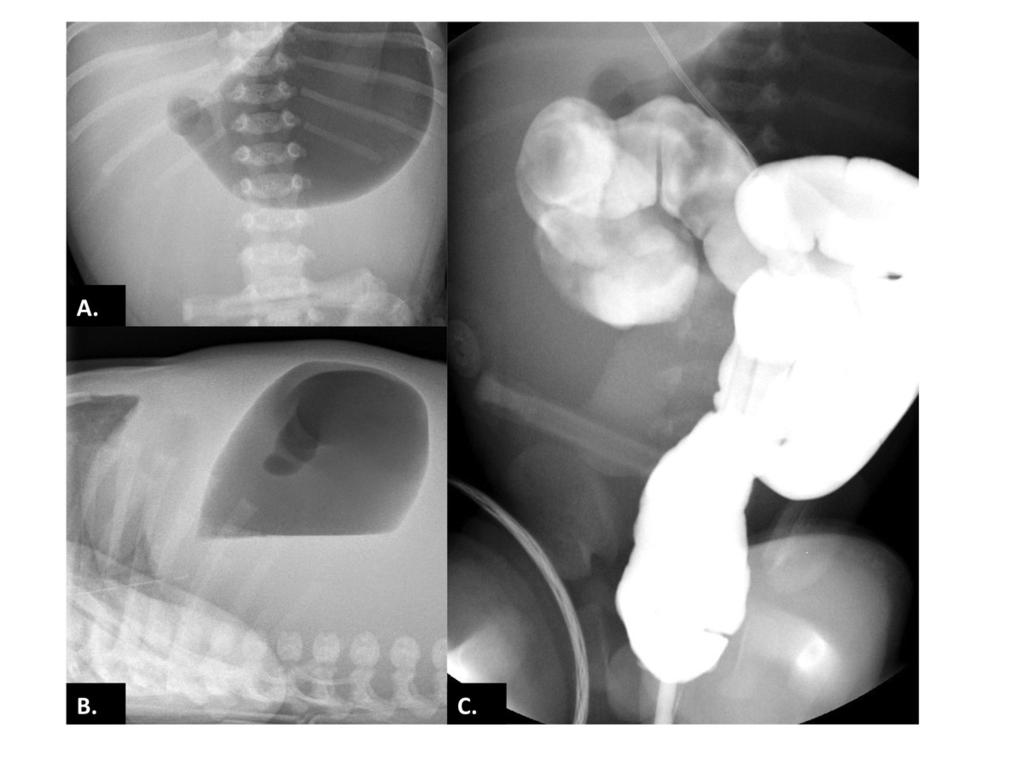 Fig. 12: Examination of a newborn presenting with abdominal distension and vomiting after birth: (A-B) X-ray of the abdomen (A-P and lateral view ) showing a marked distension of the stomach, but