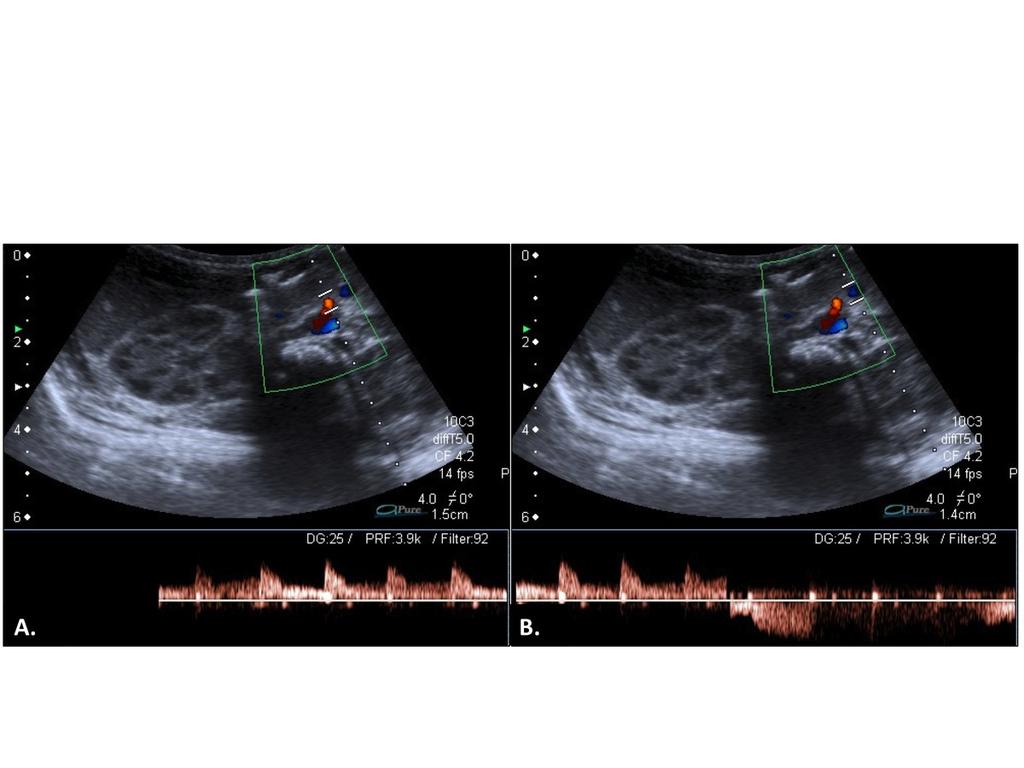 Fig. 13: Ultrasound of a newborn boy with bilious vomiting illustrating an abnormal relation between the superior mesenteric artery (SMA) and the superior mesenteric vein (SMV) in which the vein (B)