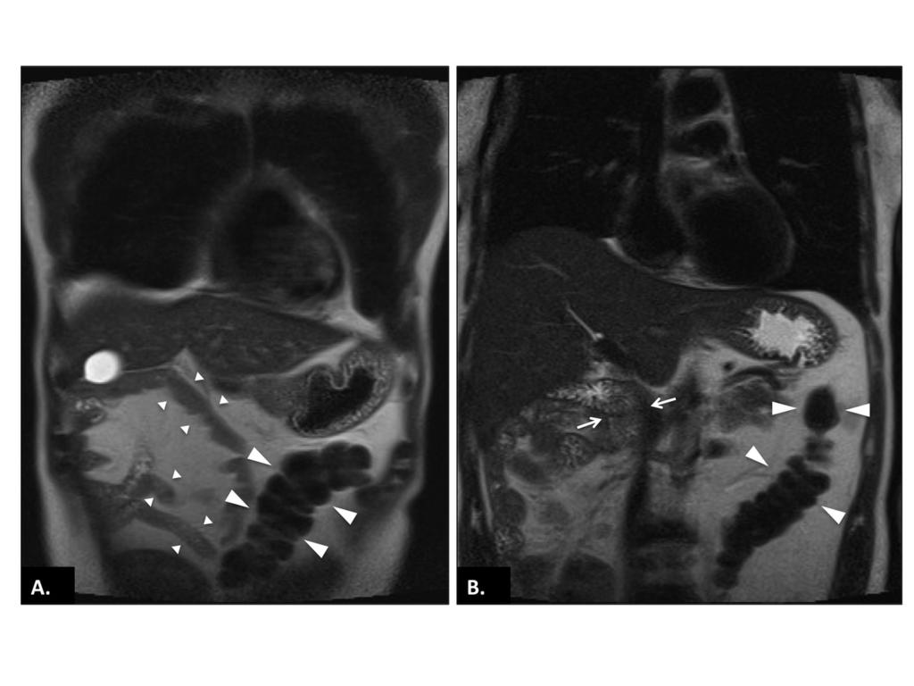 Fig. 15: MRI (coronal T2-weighted sequence) of a 55-years-old man with atypical thoracic complaints.