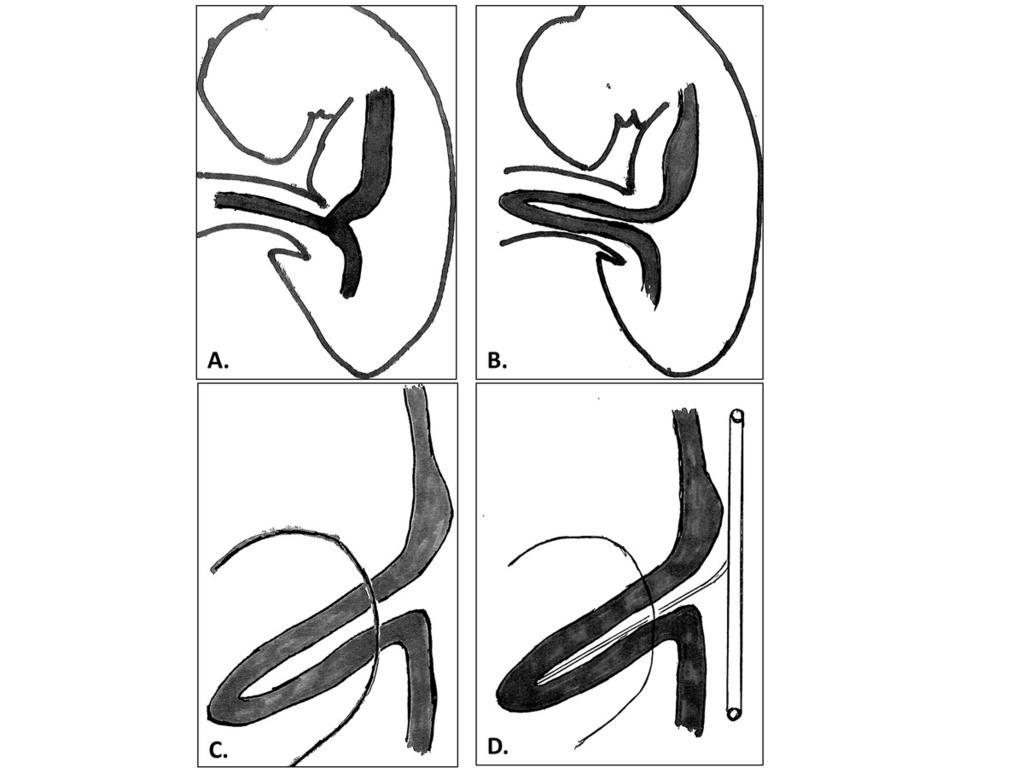 Images for this section: Fig. 1: Illustration of the initial midgut herniation through the umbilical cord from a lateral (A-B) and an anterior oblique (C-D) point of view.