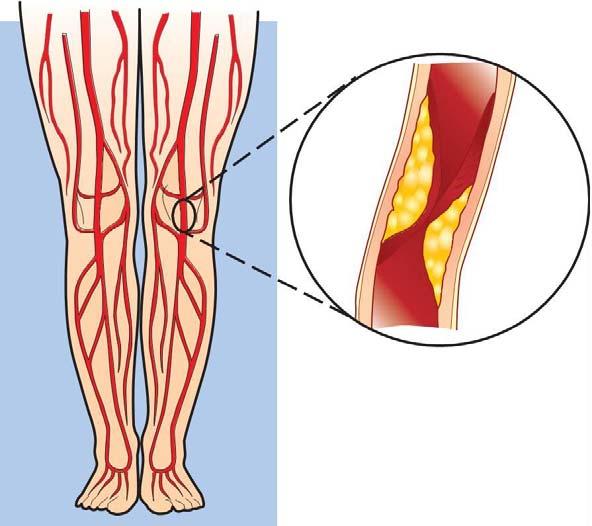 Artery narrowed by plaque Your arteries are normally smooth on the inside but they can become blocked by a process called atherosclerosis (hardening of the arteries).