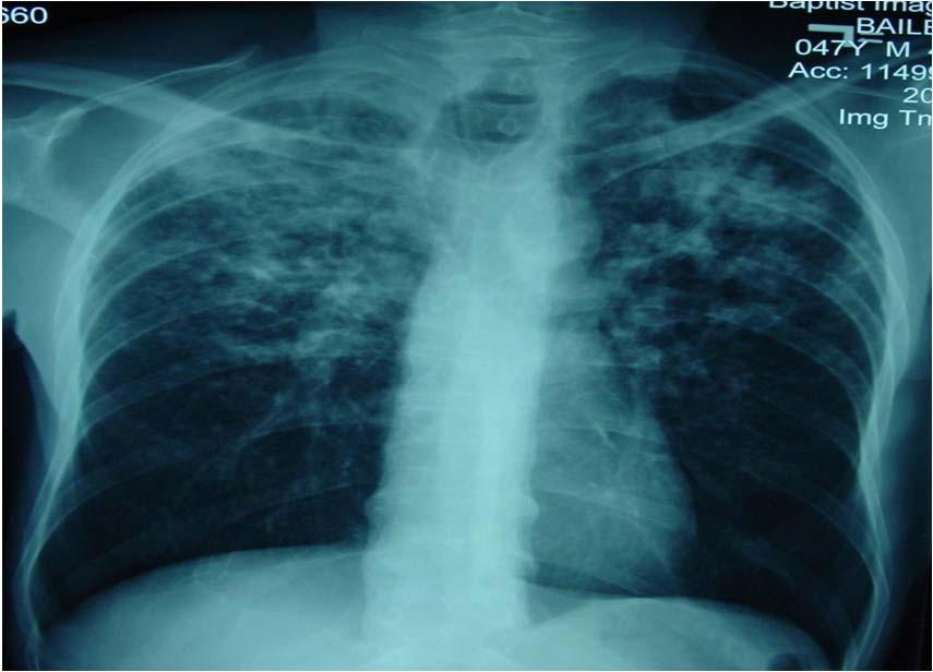 Post Primary (Reactivation) Tuberculosis Diagnostic Pearls No perfect test Evaluate but do not delay treatment Be