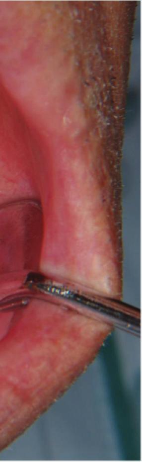 ollicular type igure 1: Intraoral findings at the first visit.
