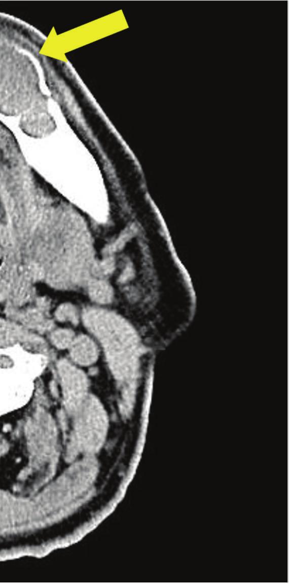 Asian igure 3: Computed tomography view. This shows thinning of peripheral bone was observed, with the bone lacking continuity in some areas.