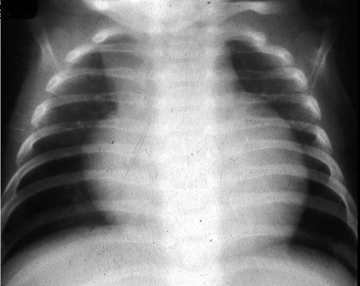 CXR (click to see results) >> Cardiac enlargement,