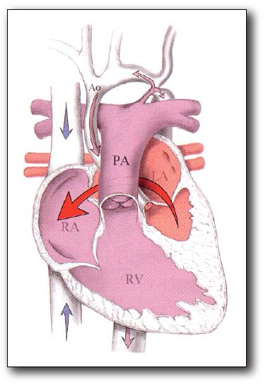 4. Hypoplastic Left Heart Syndrome A clinical spectrum that is characterized by hypoplasia of the left ventricle, severe mitral valve stenosis or atresia, or severe aortic valve stenosis or atresia,