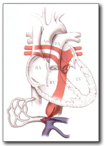 2. Truncus Arteriosus Characterized by a single arterial trunk arising from the normally formed ventricles by means of a single semilunar valve (ie, truncal