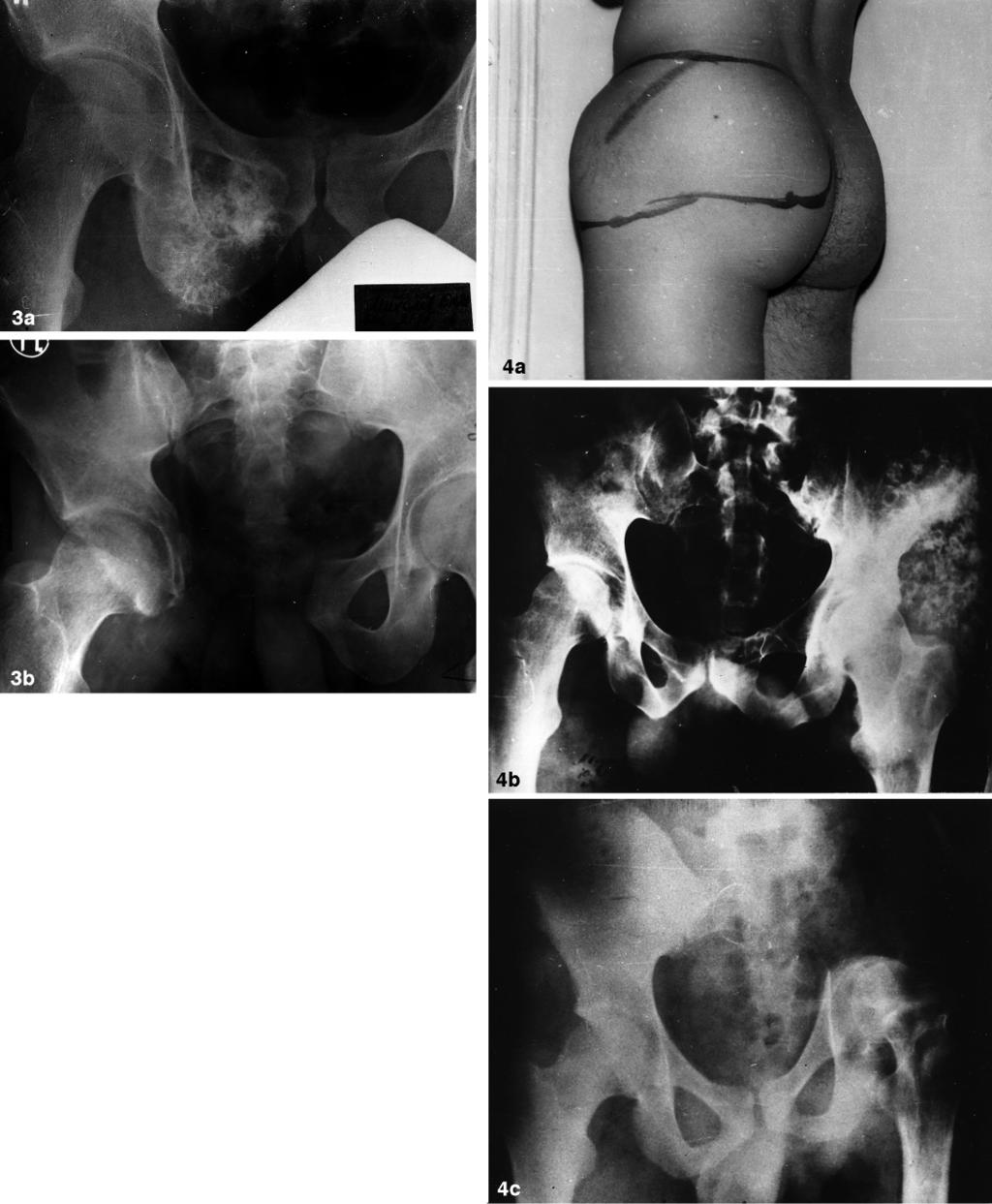44 A. Makhson: Extralesional resection of pelvic bone tumours Fig. 3 a, b. Case 3. Secondary chondrosarcoma of pubis and ischium. a Radiograph before operation.
