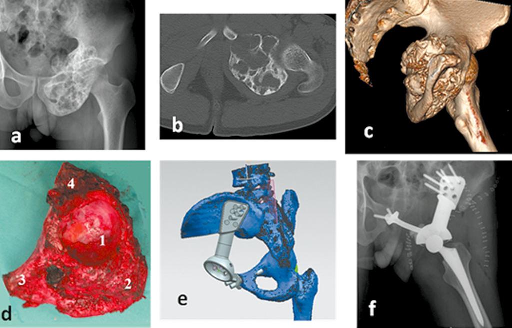 61 Fig. 1 (a) Preoperative X-ray film of the patient s pelvis. (b) Preoperative CT scan image. (c) Three-dimensional reconstruction image. (d) Photograph of en bloc dissection specimen.