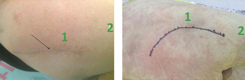 62 a b c d e Fig. 3 Photographs illustrating the posterior approach (a) Left panel: Patient s incision 2 months postoperatively (black arrow). Right panel: Line of incision shown on a cadaver.