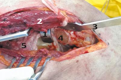 round ligament of the uterus in female patients) was identified and protected, all the adductor muscles were detached and muscle attachments to the pubis and ischium separated until the ischial
