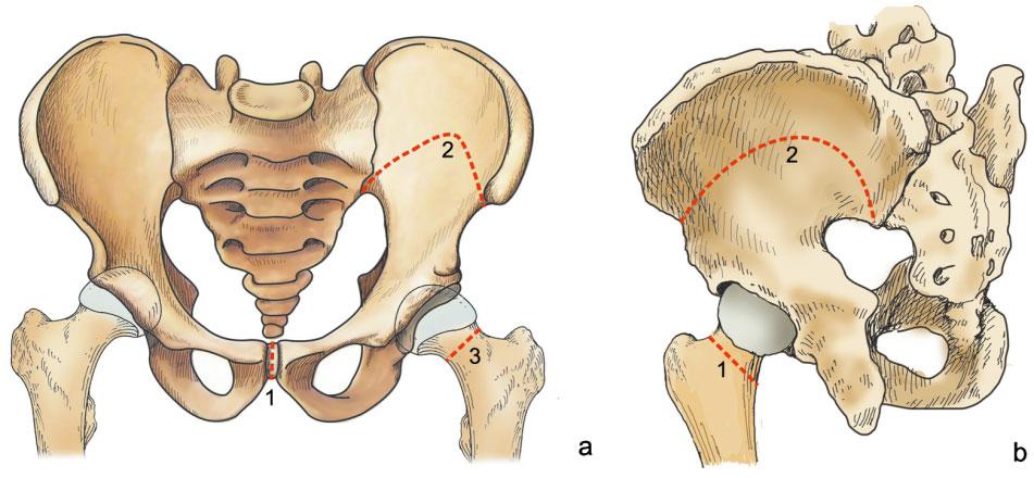 63 Fig. 5 (a) Diagrammatic representation of anterior view of osteotomy. 1, osteotomy of the pubic symphysis; 2, osteotomy of the ilium; 3, osteotomy of the femoral neck.