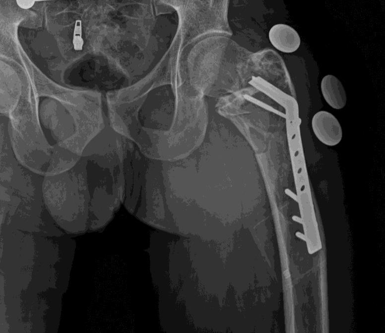 New Approach for Bone Hydatid CASE REPORT A 23-year-old man presented to Emergency Department with a low energy femur fracture. He had fractured his femur while descending the stairs.