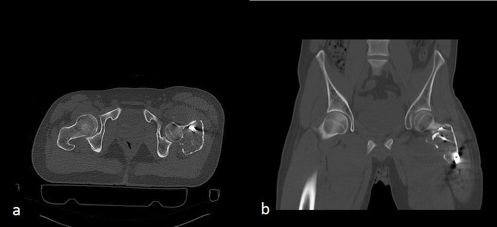 Çabuk et al Fig: 2. Axial and coronal sections of tomography of patients.