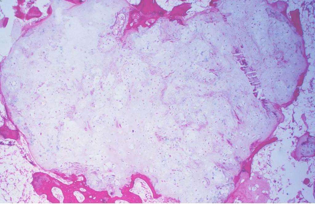 Figure 1: Figure 1: Histopathology of enchondroma: Histology shows well-differentiated, hypocellular, avascular hyaline cartilage without cellular atypia and no host bone entrapment.