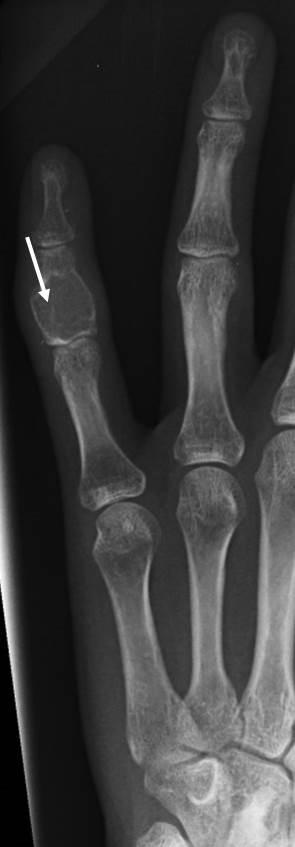 Figure 3: Figure 3: Radiograph of enchondroma of the hand: Anteroposterior radiograph of the little finger demonstrates an expansile radiolucent lesion of the middle phalanx which shows