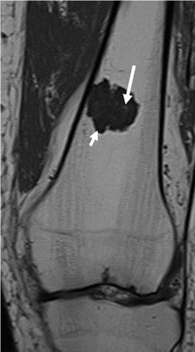 Figure 5: Figure 5a: Figure 5b: Figure 5: MRI of enchondroma of the distal femur: Coronal T1W SE MRI (a) and coronal T2W FS MRI (b)