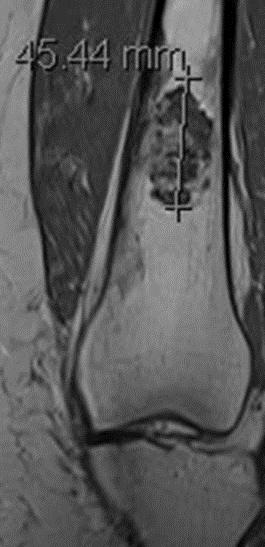 Figure 7: Figure 7a: Figure 7b: Figure 7: MRI and bone scintigraphy of enchondroma of the left distal femur.