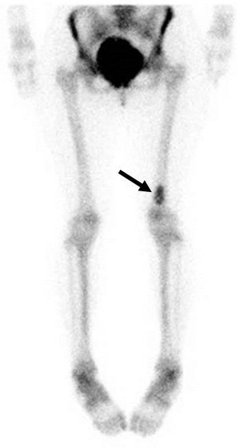 Figure 8: Figure 8: Bone scintigraphy of enchondroma of the left distal femur.