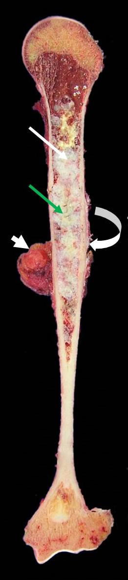 Figure 9: Figure 9: Macroscopic pathology of a chondrosarcoma of the humerus.