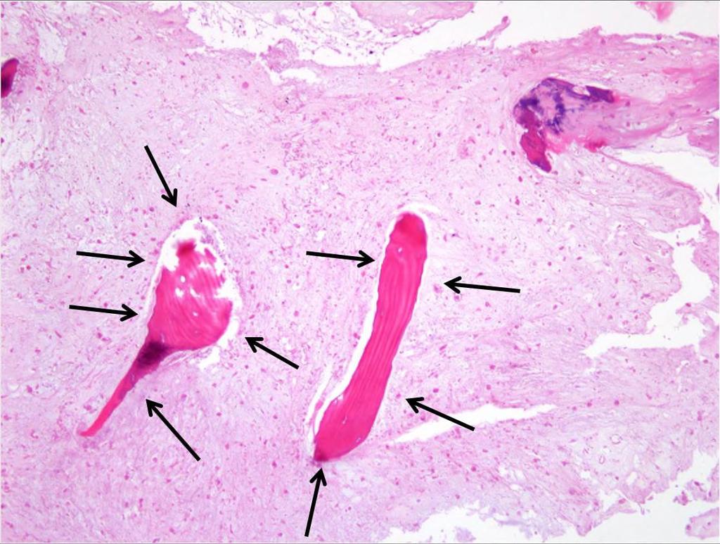 Figure 10: Figure 10: Histopathology of a grade 1 chondrosarcoma: The specimen demonstrates the hallmark of a grade 1 chondrosarcoma: the presence of