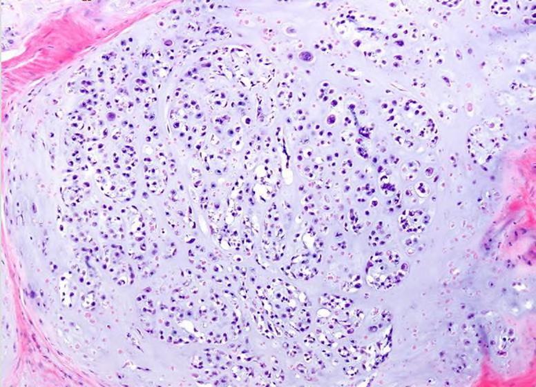 Figure 12: Figure 12: Histopathology of a grade 2 chondrosarcoma: The chondrocytes demonstrate more nuclear atypia and