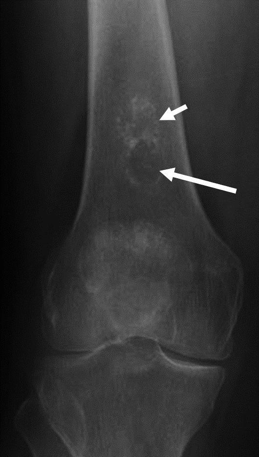 Figure 14: Figure 14: Radiograph of low-grade chondrosarcoma of distal femur.