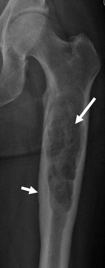 Figure 16: Figure 16: Radiograph of a high-grade chondrosarcoma of the proximal femur.