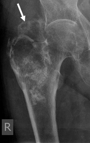Figure 17: Figure 17: Radiograph of a high-grade chondrosarcoma of the proximal femur.