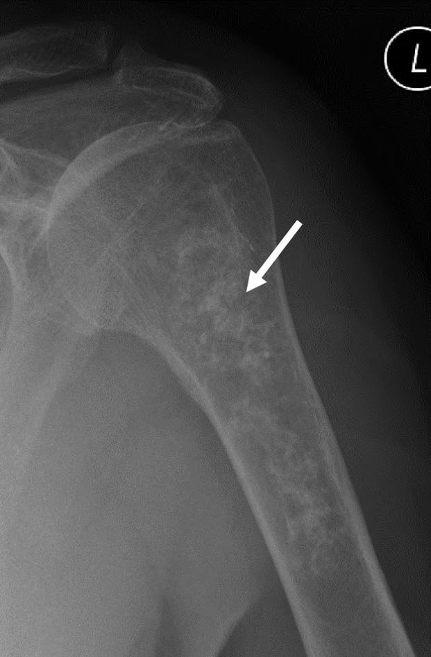 Figure 18: Figure 18: Radiograph of a low-grade chondrosarcoma of the left proximal humerus.