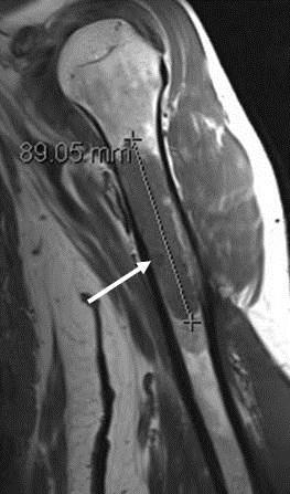 Figure 20 Figure 20a: Figure 20b: Figure 20: MRI of a chondrosarcoma of the proximal humerus.
