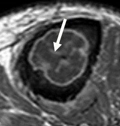 Coronal T1W SE MRI (a) and gadolinium-enhanced T1W MRI (b) of the tibia