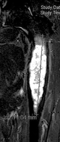 Figure 22 Figure 22a: Figure 22b: Figure 22: MRI of a chondrosarcoma of the proximal femur.