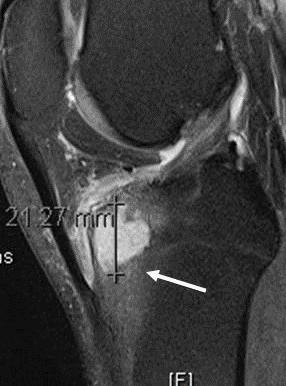 Figure 23: Figure 23a: Figure 23b: Figure 23: MRI of a grade 1 chondrosarcoma of the proximal tibia.