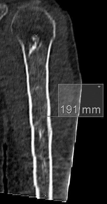 humeral head (a, arrow). On FDG-PET/CT (b), the lesion demonstrates increased FDG-uptake with an SUVmax of 3.6.