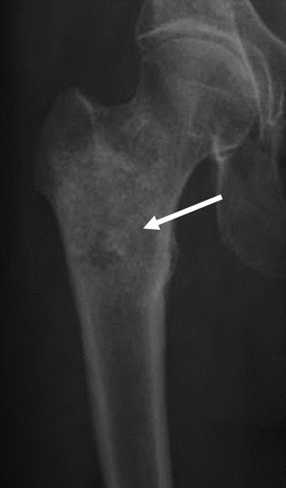 Figure 26 Figure 26a: Figure 26b: Figure 26: Chondrosarcoma of the proximal femur.