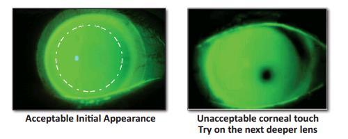 Fitting Procedure Our initial lens was ICD 16.5 SPHERE 4500μ as recommended in the manufacturer s fitting table. The fluorescein pattern showed central touch.