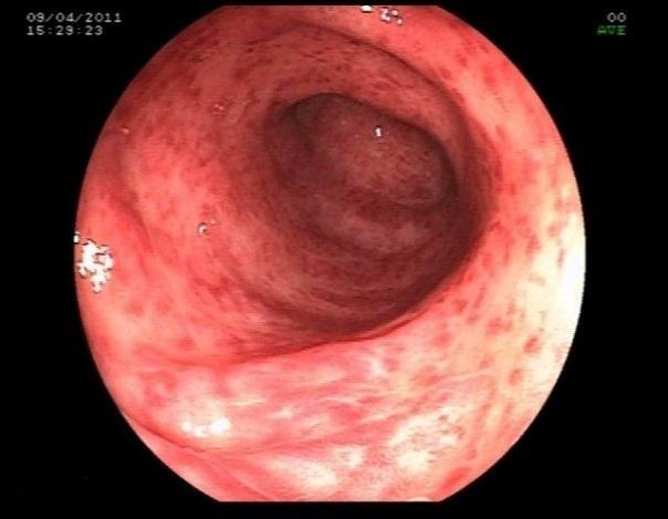 Endoscopy Active inflammation up to 45 cm Complete loss of vascular pattern, moderate friability with bleeding upon contact Small erosions, but no large or deep ulcers A
